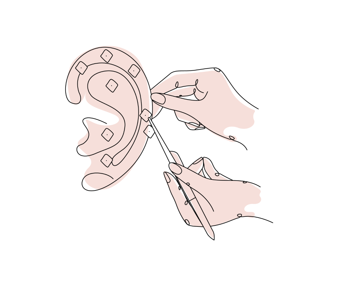 Auriculotherapy