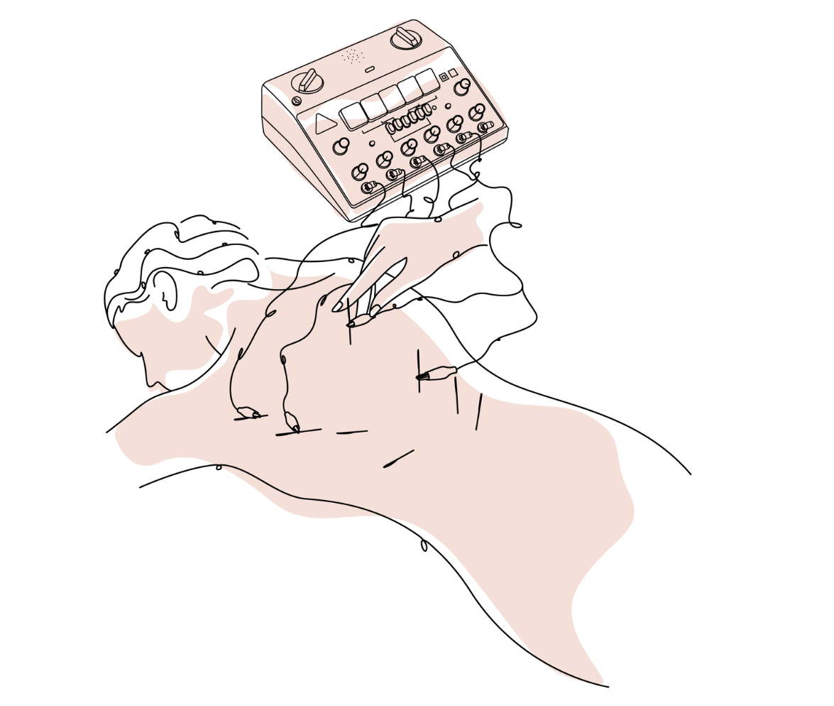 Electro Acupuncture